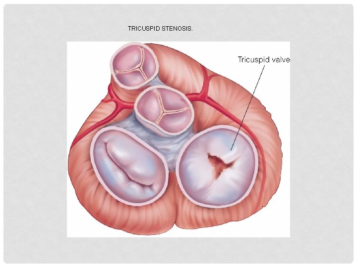 TRICUSPID STENOSIS. 