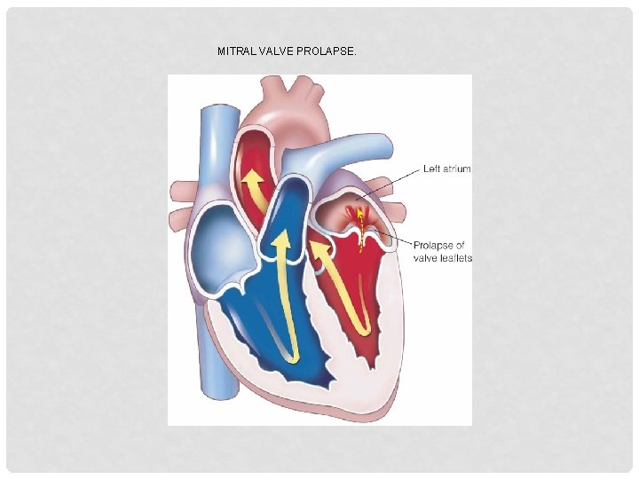 MITRAL VALVE PROLAPSE. 