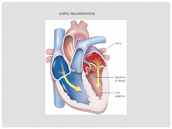 AORTIC REGURGITATION. 