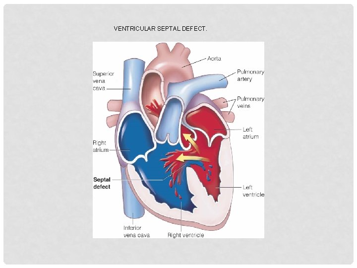 VENTRICULAR SEPTAL DEFECT. 