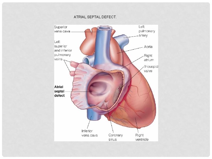 ATRIAL SEPTAL DEFECT. 