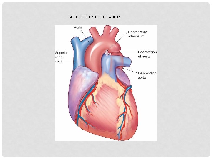 COARCTATION OF THE AORTA. 