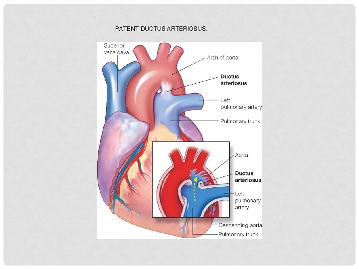 PATENT DUCTUS ARTERIOSUS. 