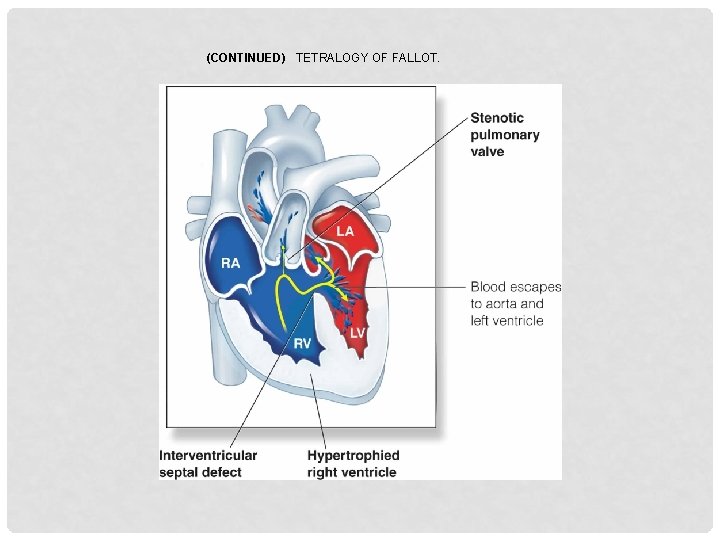 (CONTINUED) TETRALOGY OF FALLOT. 
