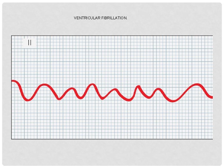 VENTRICULAR FIBRILLATION. 