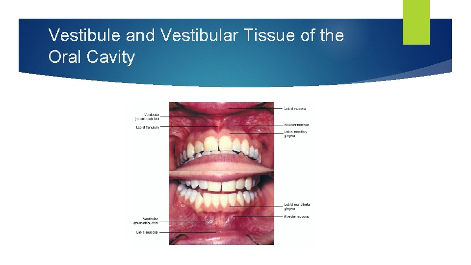 Vestibule and Vestibular Tissue of the Oral Cavity 