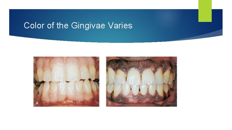 Color of the Gingivae Varies 