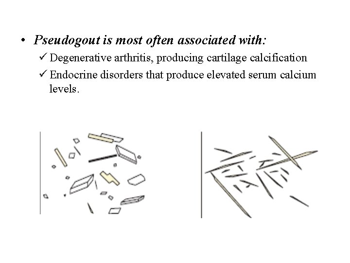  • Pseudogout is most often associated with: ü Degenerative arthritis, producing cartilage calcification