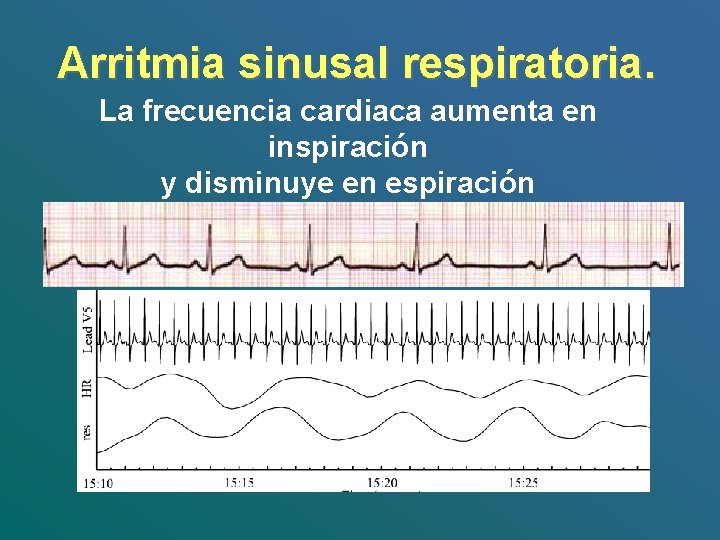 Arritmia sinusal respiratoria. La frecuencia cardiaca aumenta en inspiración y disminuye en espiración Arritmia sinusal respiratoria. La frecuencia cardiaca aumenta en inspiración y disminuye en espiración
