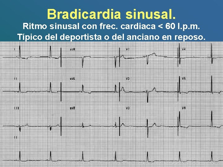 Bradicardia sinusal. Ritmo sinusal con frec. cardiaca < 60 l. p. m. Típico del