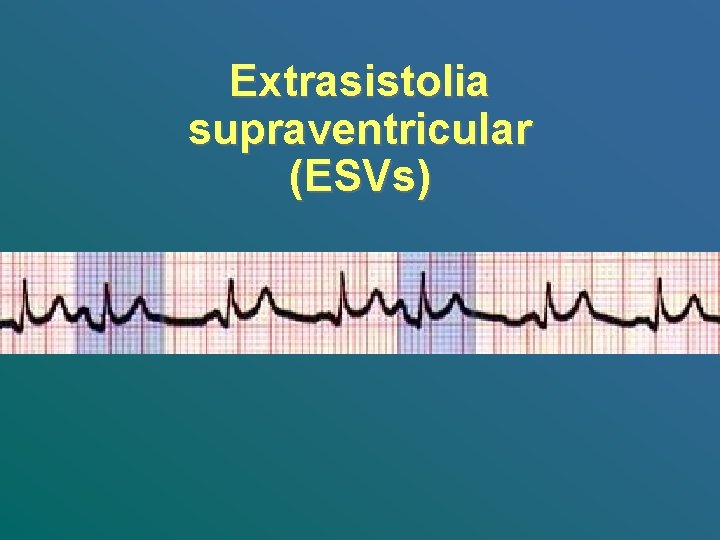 Extrasistolia supraventricular (ESVs) 