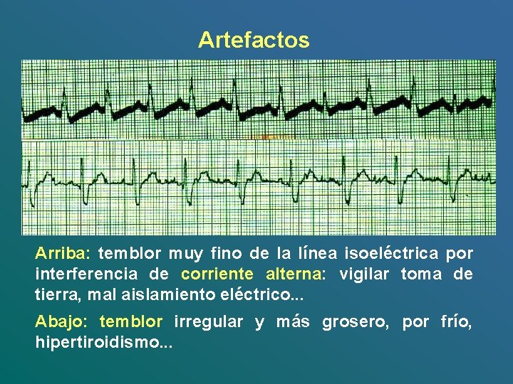 Artefactos Arriba: temblor muy fino de la línea isoeléctrica por interferencia de corriente alterna: Artefactos Arriba: temblor muy fino de la línea isoeléctrica por interferencia de corriente alterna: