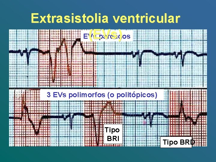 Extrasistolia ventricular EVs pareados (EVs) 3 EVs polimorfos (o politópicos) Tipo BRI Tipo BRD