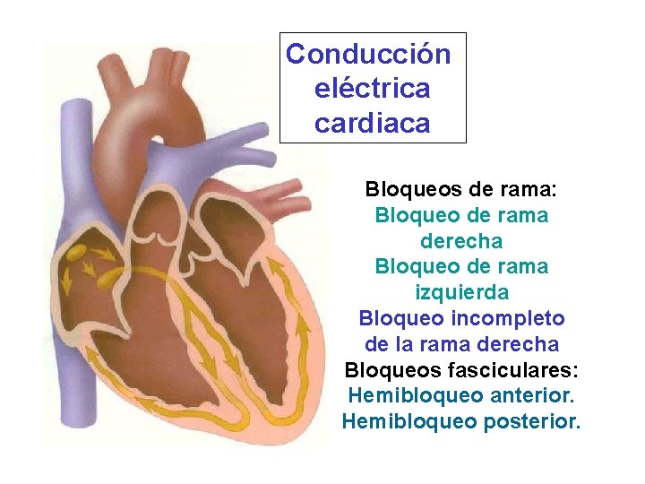 Conducción eléctrica cardiaca Bloqueos de rama: Bloqueo de rama derecha Bloqueo de rama izquierda