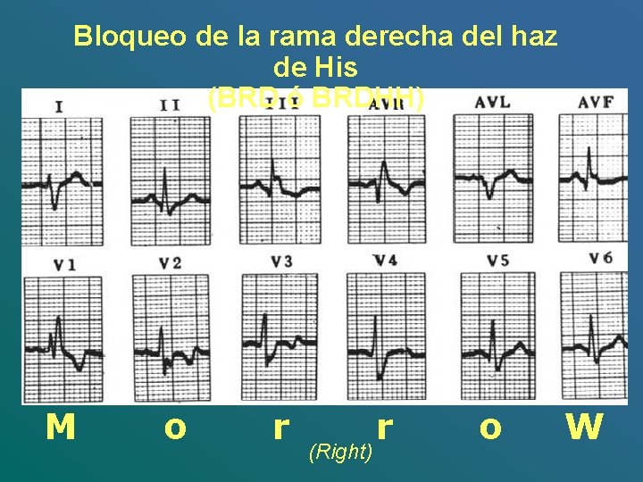 Bloqueo de la rama derecha del haz de His (BRD ó BRDHH) M o