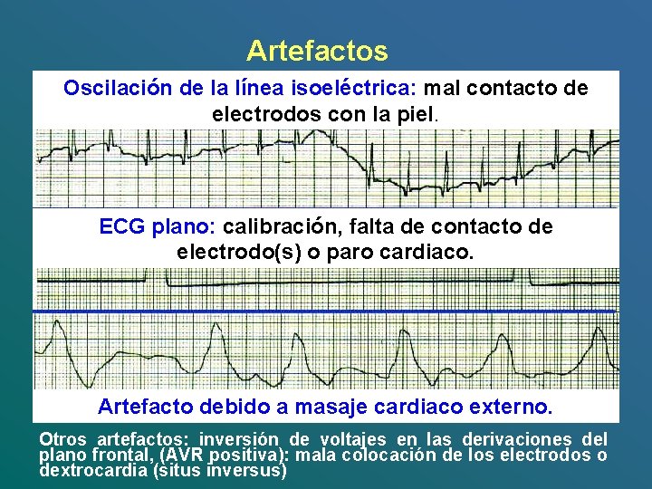 Artefactos Oscilación de la línea isoeléctrica: mal contacto de electrodos con la piel. ECG Artefactos Oscilación de la línea isoeléctrica: mal contacto de electrodos con la piel. ECG