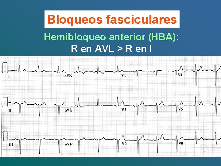 Bloqueos fasciculares Hemibloqueo anterior (HBA): R en AVL > R en I 