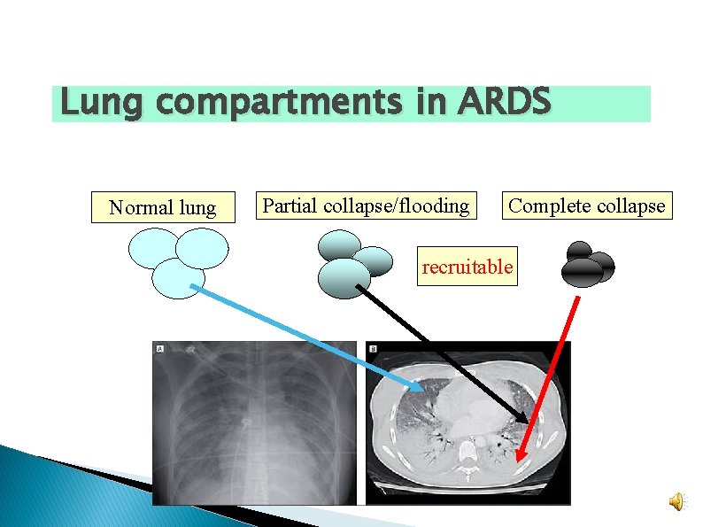 Lung compartments in ARDS Normal lung Partial collapse/flooding Complete collapse recruitable Lung compartments in ARDS Normal lung Partial collapse/flooding Complete collapse recruitable
