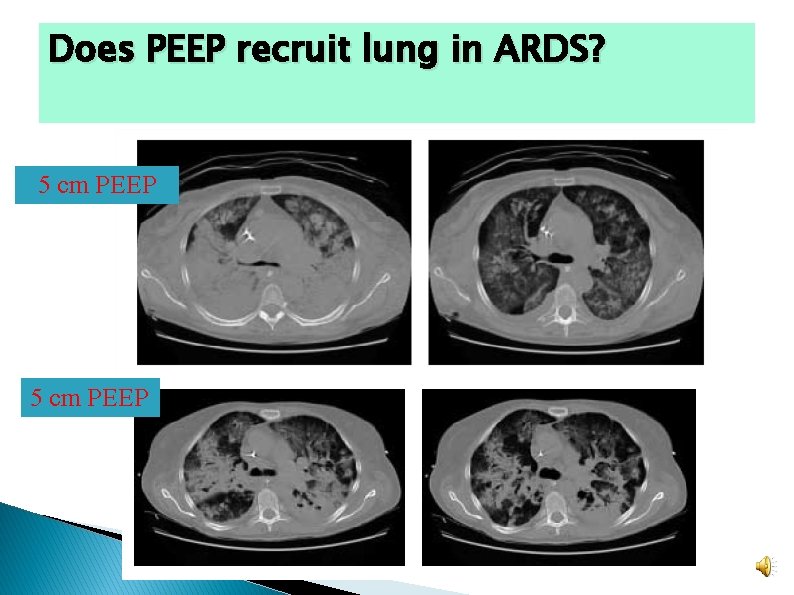 Does PEEP recruit lung in ARDS? 5 cm PEEP Does PEEP recruit lung in ARDS? 5 cm PEEP