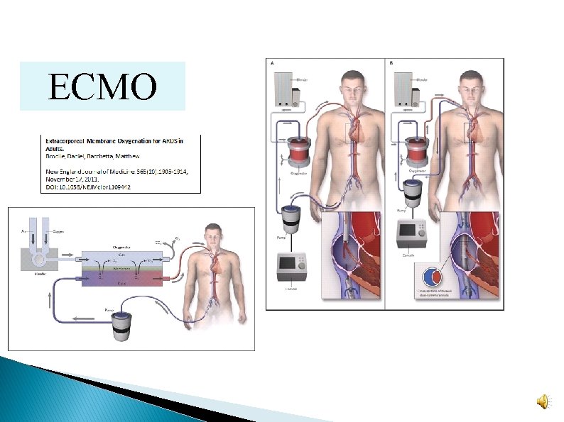 ECMO ECMO