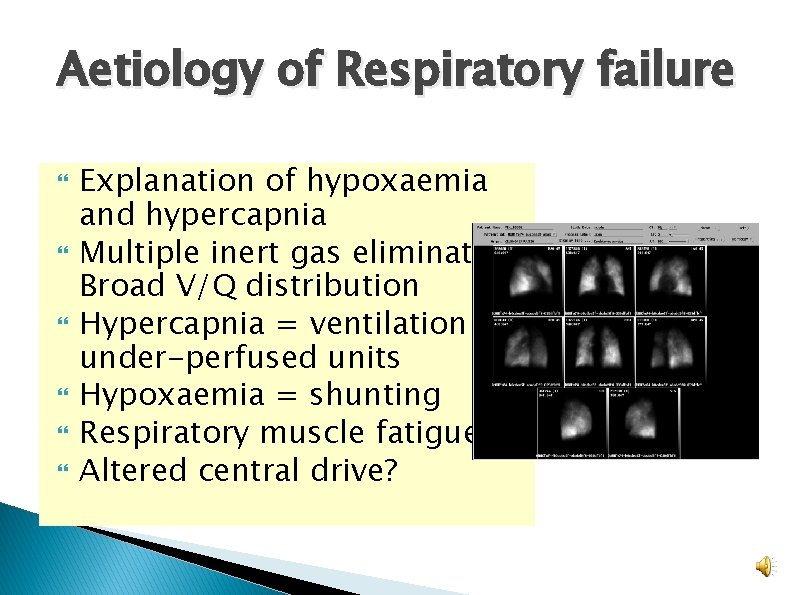 Aetiology of Respiratory failure Explanation of hypoxaemia and hypercapnia Multiple inert gas elimination Broad Aetiology of Respiratory failure Explanation of hypoxaemia and hypercapnia Multiple inert gas elimination Broad