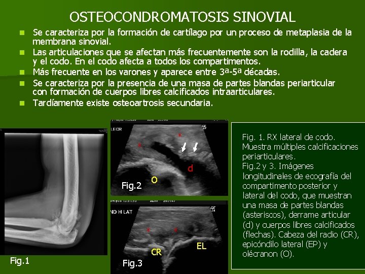 OSTEOCONDROMATOSIS SINOVIAL n n n Se caracteriza por la formación de cartílago por un