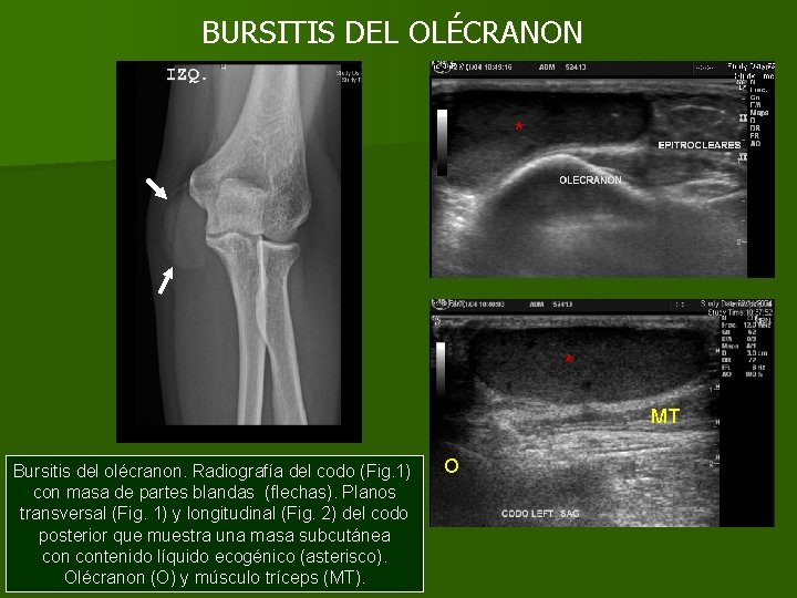 BURSITIS DEL OLÉCRANON * * MT Bursitis del olécranon. Radiografía del codo (Fig. 1)