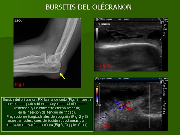 BURSITIS DEL OLÉCRANON * Fig. 2 * Fig. 1 Bursitis del olécranon. RX lateral