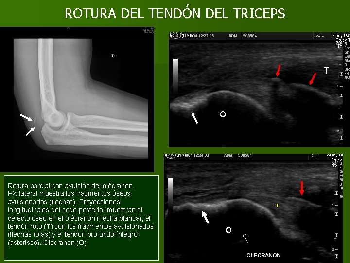 ROTURA DEL TENDÓN DEL TRICEPS T O Rotura parcial con avulsión del olécranon. RX