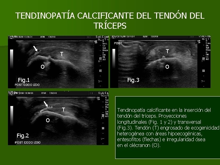 TENDINOPATÍA CALCIFICANTE DEL TENDÓN DEL TRÍCEPS T T O O Fig. 1 Fig. 3