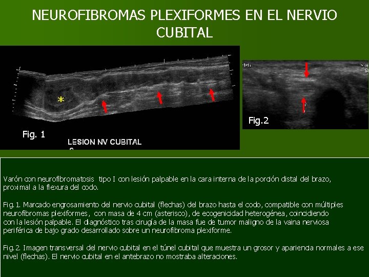 NEUROFIBROMAS PLEXIFORMES EN EL NERVIO CUBITAL * Fig. 2 Fig. 1 Varón con neurofibromatosis