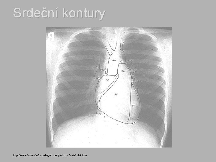 Srdeční kontury http: //www. bcm. edu/radiology/cases/pediatric/text/7 a 1 A. htm 