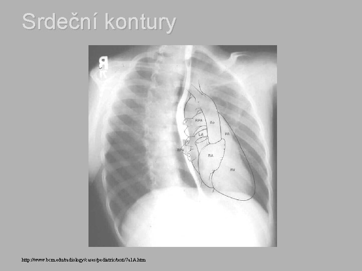 Srdeční kontury http: //www. bcm. edu/radiology/cases/pediatric/text/7 a 1 A. htm 