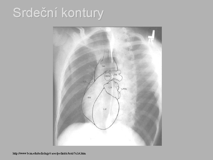 Srdeční kontury http: //www. bcm. edu/radiology/cases/pediatric/text/7 a 1 A. htm 