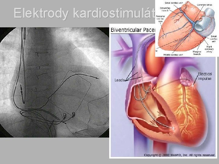 Elektrody kardiostimulátoru 