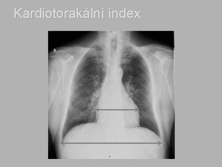 Kardiotorakální index 