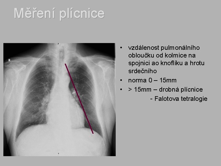 Měření plícnice • vzdálenost pulmonálního obloučku od kolmice na spojnici ao knoflíku a hrotu
