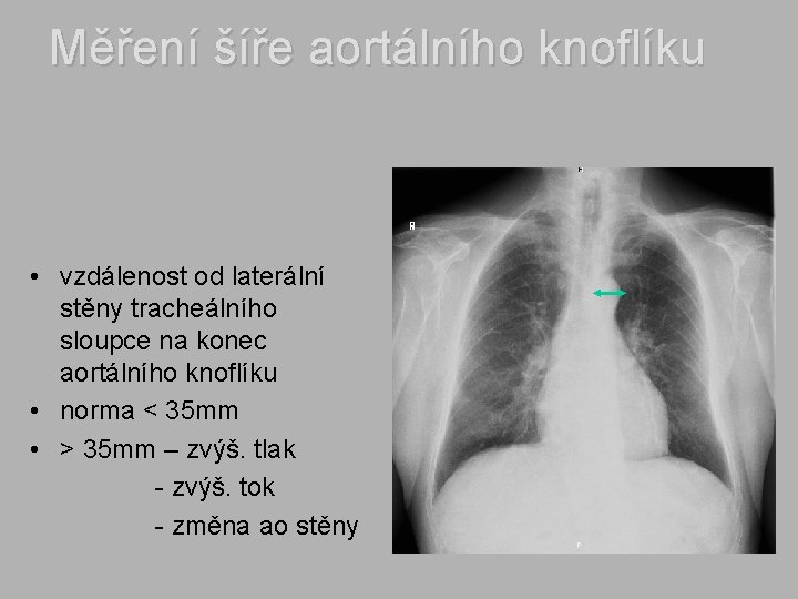 Měření šíře aortálního knoflíku • vzdálenost od laterální stěny tracheálního sloupce na konec aortálního