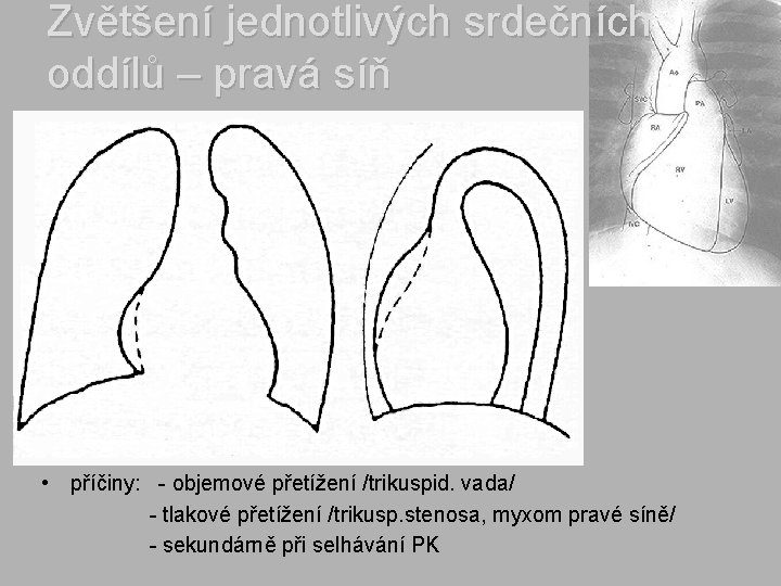 Zvětšení jednotlivých srdečních oddílů – pravá síň • příčiny: - objemové přetížení /trikuspid. vada/