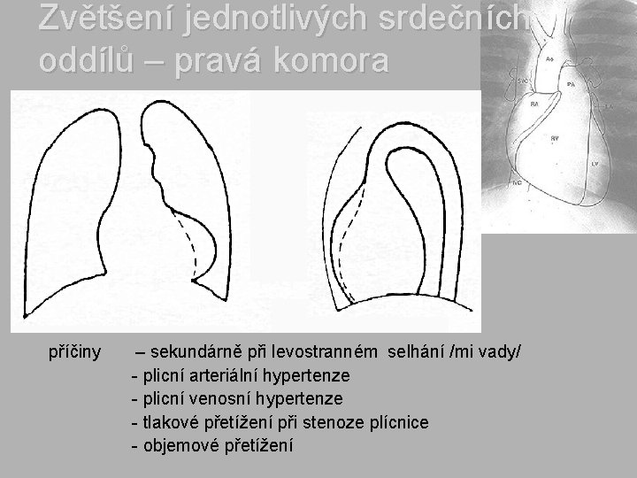 Zvětšení jednotlivých srdečních oddílů – pravá komora příčiny – sekundárně při levostranném selhání /mi