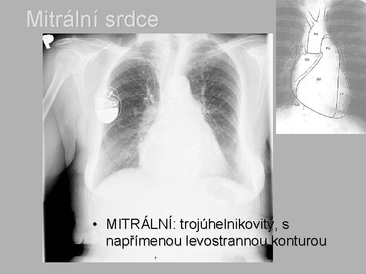 Mitrální srdce • MITRÁLNÍ: trojúhelnikovitý, s napřímenou levostrannou konturou 