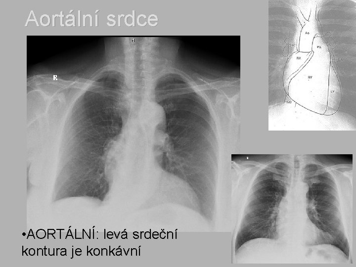 Aortální srdce • AORTÁLNÍ: levá srdeční kontura je konkávní 