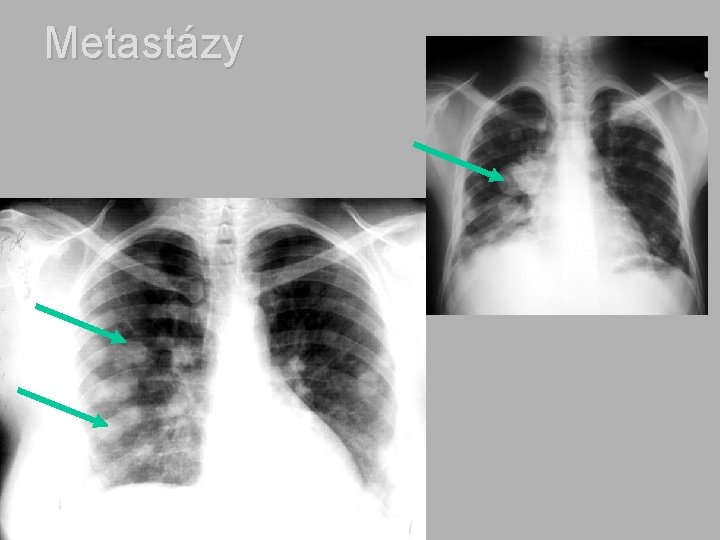 Metastázy 