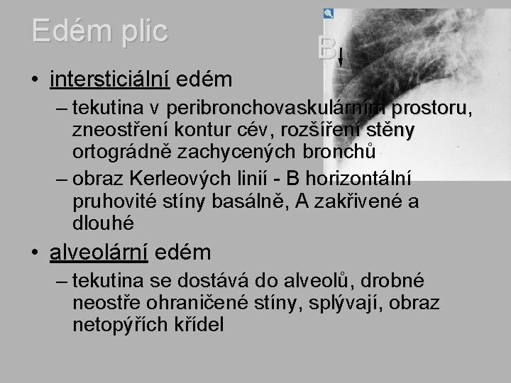 Edém plic • intersticiální edém B – tekutina v peribronchovaskulárním prostoru, prostoru zneostření kontur