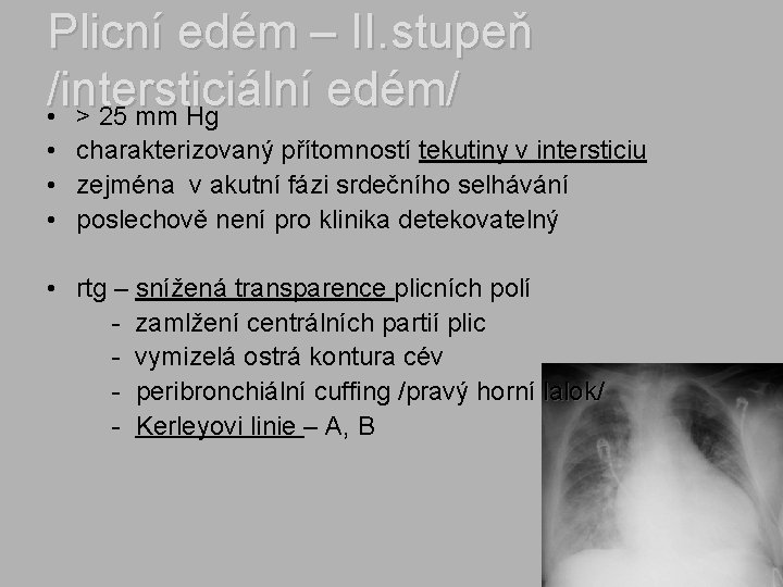 Plicní edém – II. stupeň /intersticiální edém/ • > 25 mm Hg • charakterizovaný