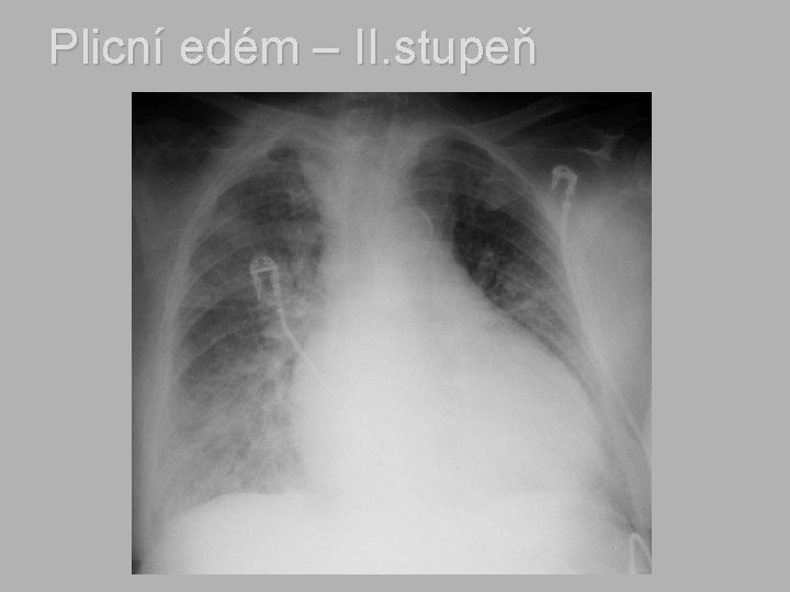 Plicní edém – II. stupeň 