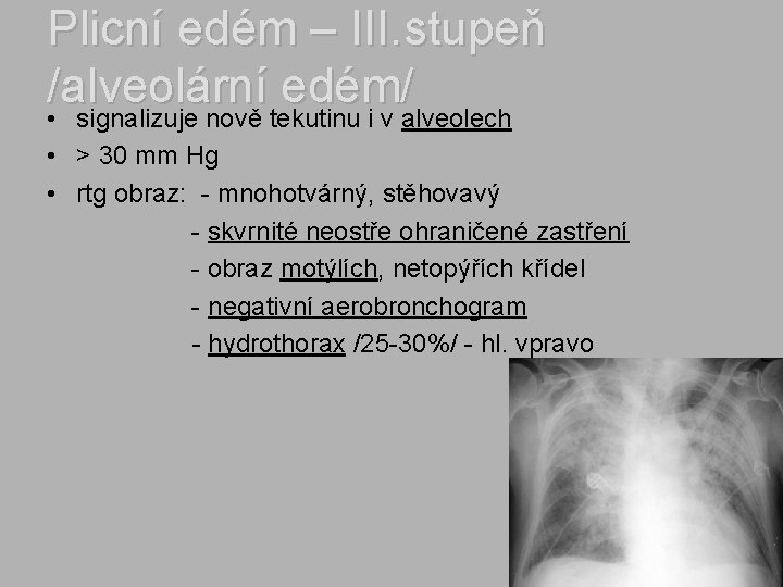 Plicní edém – III. stupeň /alveolární edém/ • signalizuje nově tekutinu i v alveolech