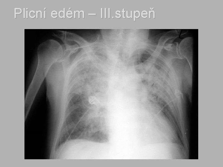 Plicní edém – III. stupeň 