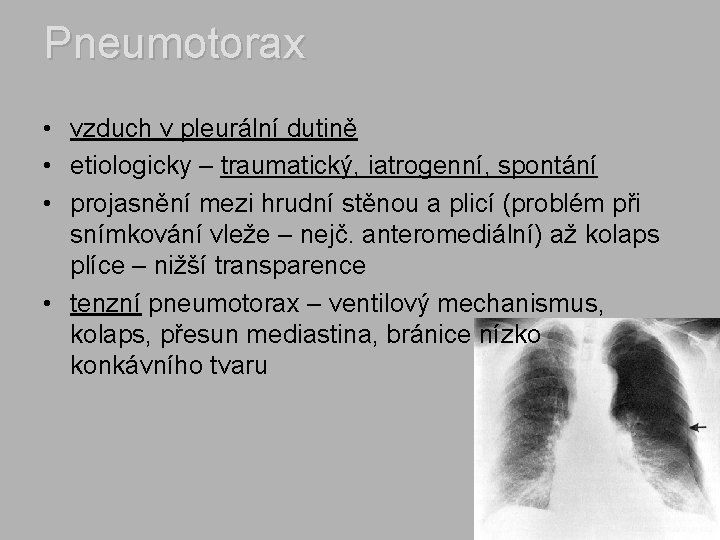 Pneumotorax • vzduch v pleurální dutině • etiologicky – traumatický, iatrogenní, spontání • projasnění