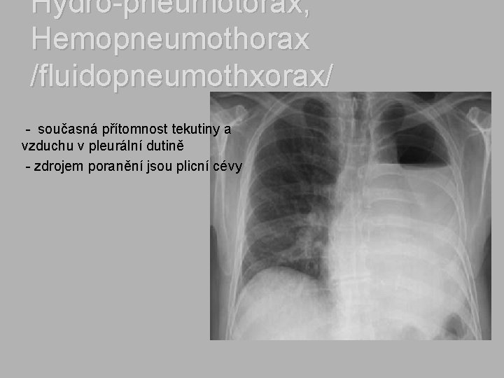 Hydro-pneumotorax, Hemopneumothorax /fluidopneumothxorax/ - současná přítomnost tekutiny a vzduchu v pleurální dutině - zdrojem